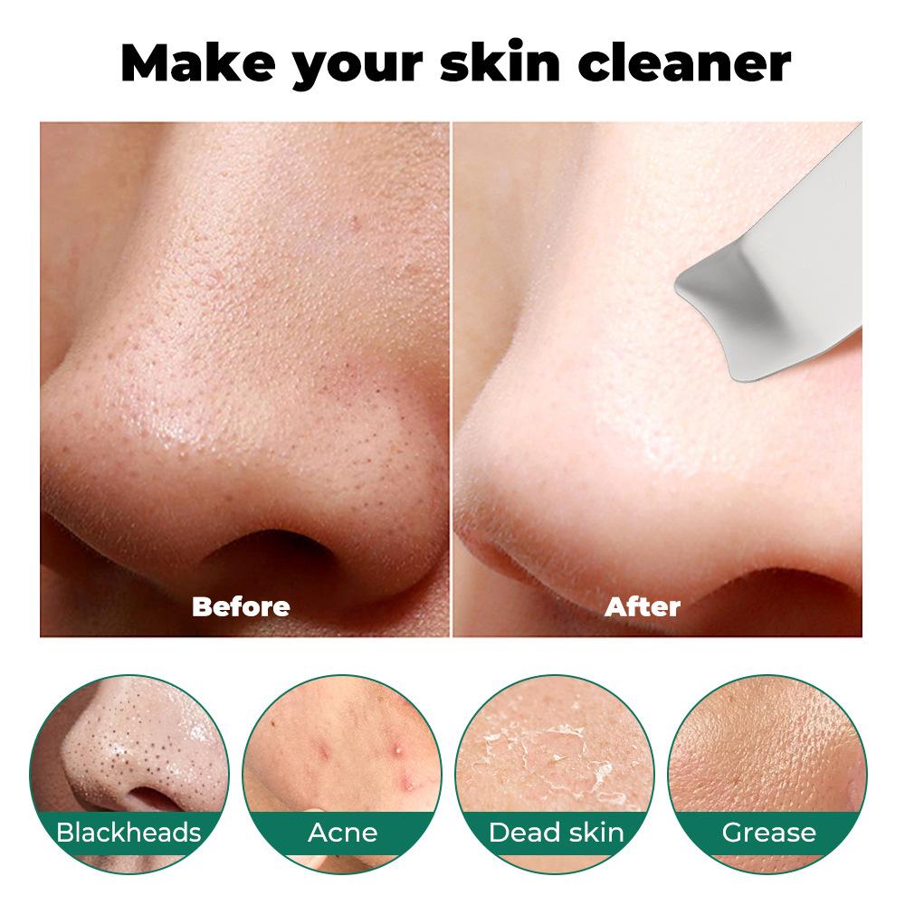 Ultrasonic Blackhead Removal Machine Import And Export Beauty Device 8