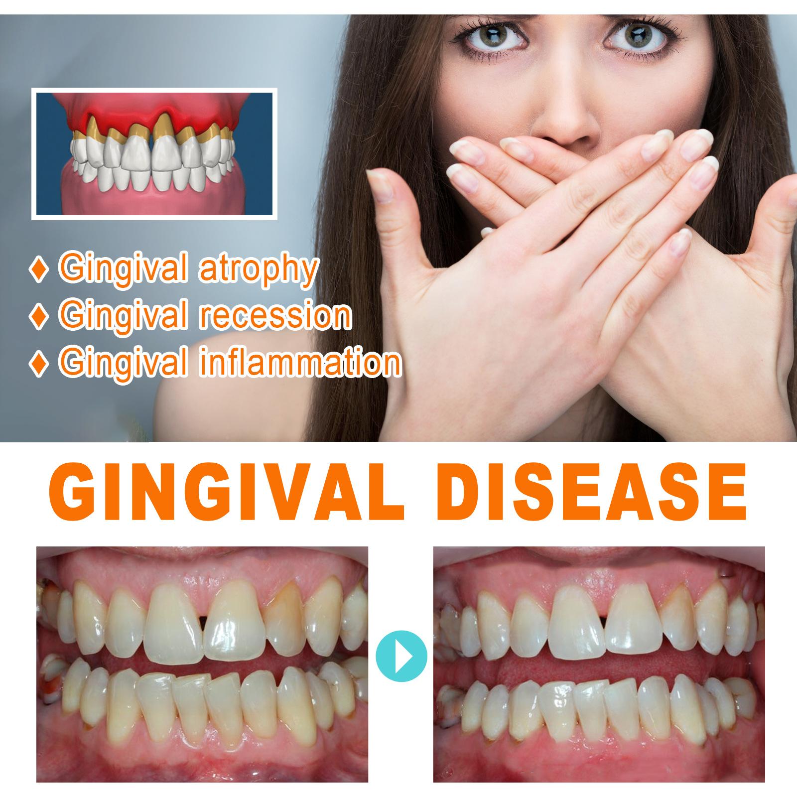 Teeth Repair Deep Cleaning Teeth Yellow Teeth Stain Tartar Care Gum Oral Care 13