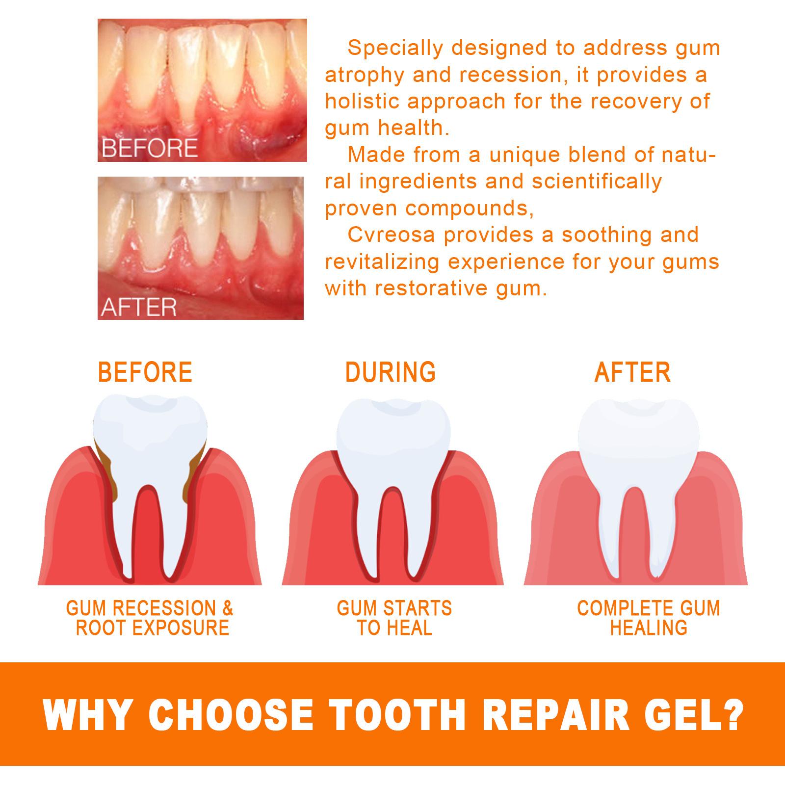 Teeth Repair Deep Cleaning Teeth Yellow Teeth Stain Tartar Care Gum Oral Care 15